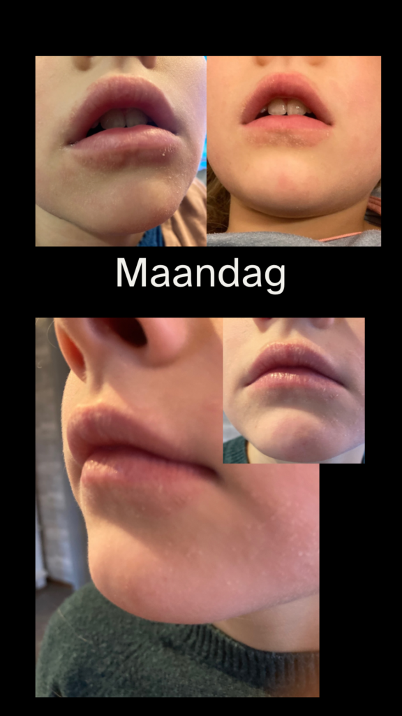 droge lippen
