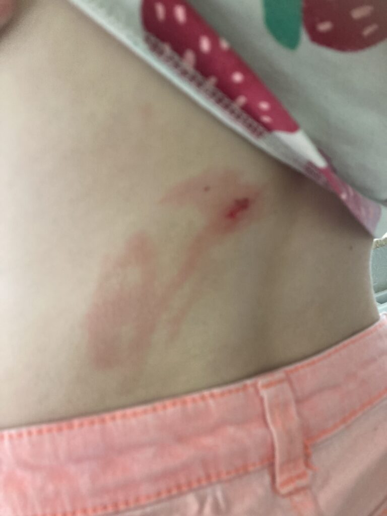 processierups uitslag